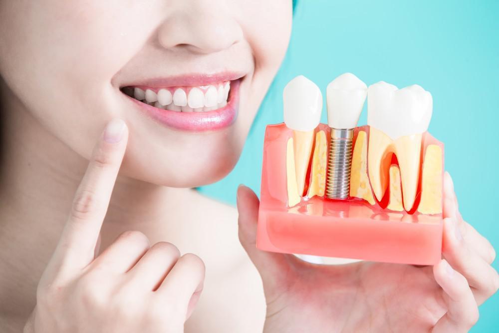 How To Care For Your Dental Implants After Surgery 1 How To Care For Your Dental Implants After Surgery